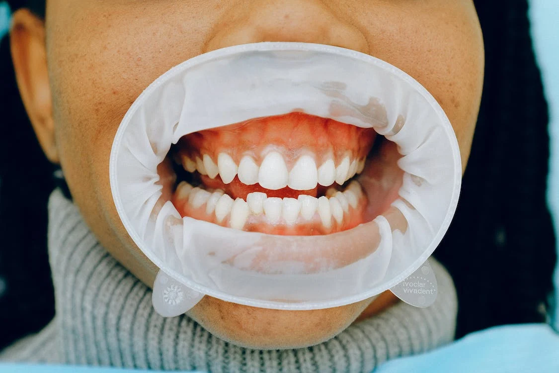 Woman-teeth