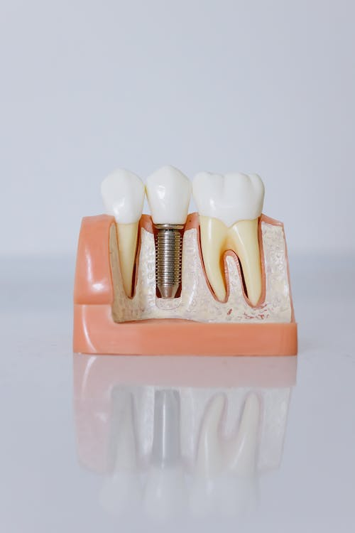 A close-up of a dental implant model