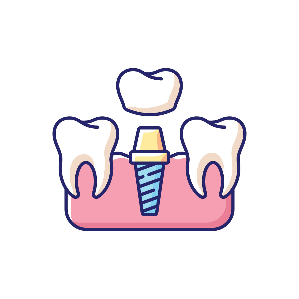 Dental Implants Dental Implants