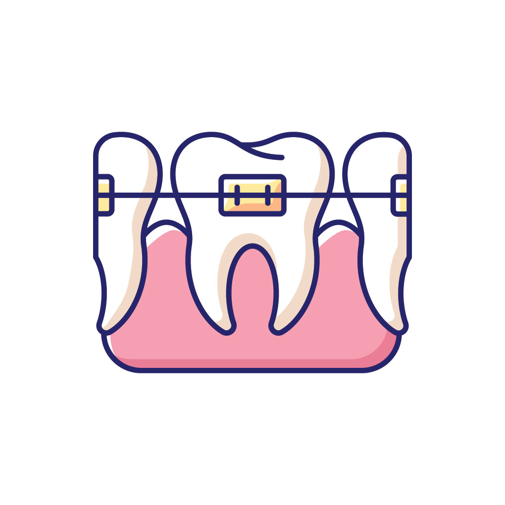 Invisalign Invisalign